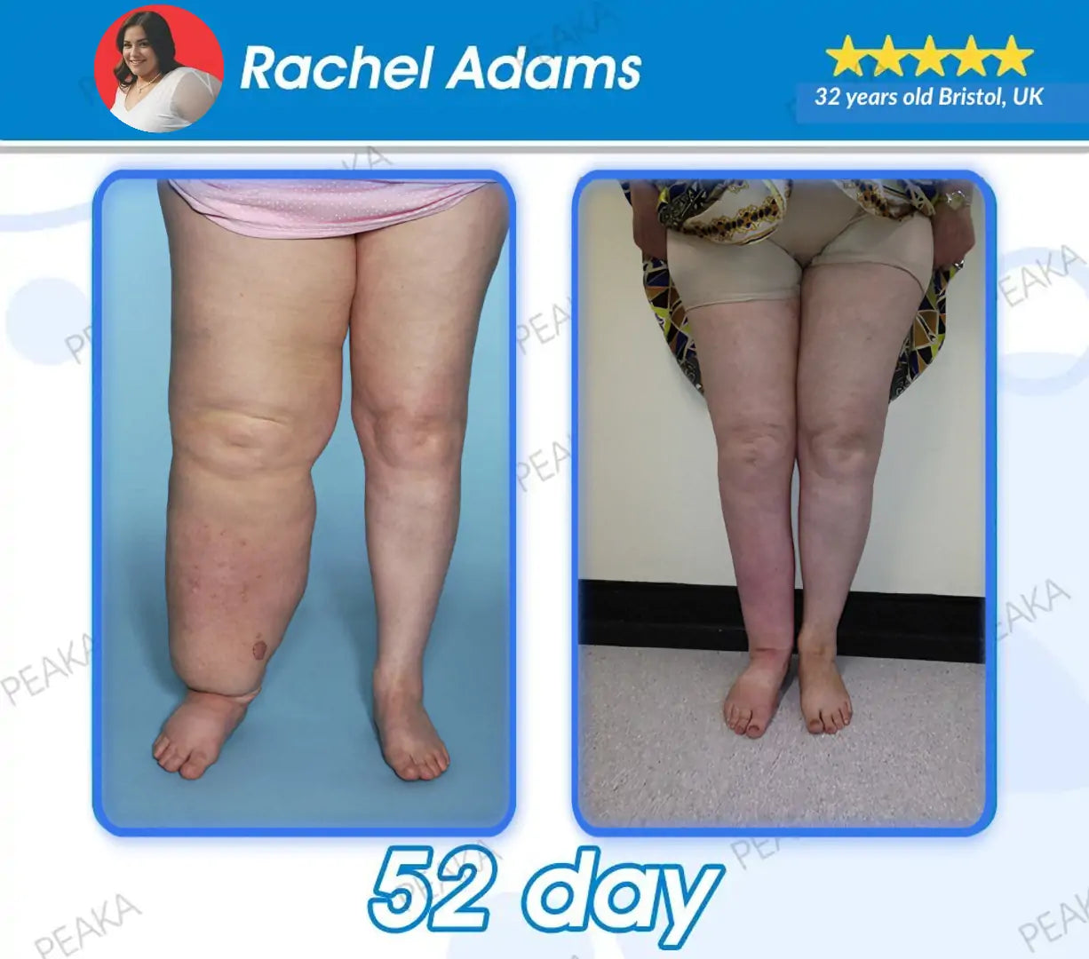 𝐎𝐟𝐟𝐢𝐜𝐢𝐚𝐥 𝐔𝐊 𝐒𝐭𝐨𝐫𝐞 | 𝐏𝐄𝐀𝐊𝐀® 𝐆𝐋𝐏-𝟏 𝐒𝐥𝐢𝐦𝐦𝐢𝐧𝐠 𝐋𝐢𝐪𝐮𝐢𝐝 𝐏𝐞𝐚𝐫𝐥𝐬– 𝐖𝐢𝐭𝐡 𝐍𝐀𝐃+, 𝐌𝐨𝐫𝐢𝐧𝐠𝐚, 𝐀𝐩𝐩𝐥𝐞 𝐂𝐢𝐝𝐞𝐫 𝐕𝐢𝐧𝐞𝐠𝐚𝐫 & 𝐊𝐞𝐭𝐨 𝐁𝐇𝐁 | 𝐅𝐚𝐬𝐭-𝐀𝐜𝐭𝐢𝐧𝐠, 𝐄𝐱𝐩𝐞𝐫𝐭-𝐃𝐞𝐯𝐞𝐥𝐨𝐩𝐞𝐝 𝐅𝐨𝐫𝐦𝐮𝐥𝐚 𝐟𝐨𝐫 𝐖𝐞𝐢𝐠𝐡𝐭 & 𝐇𝐞𝐚𝐥𝐭𝐡 𝐒𝐮𝐩𝐩𝐨𝐫𝐭